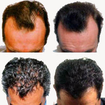 Dandruff Treatment